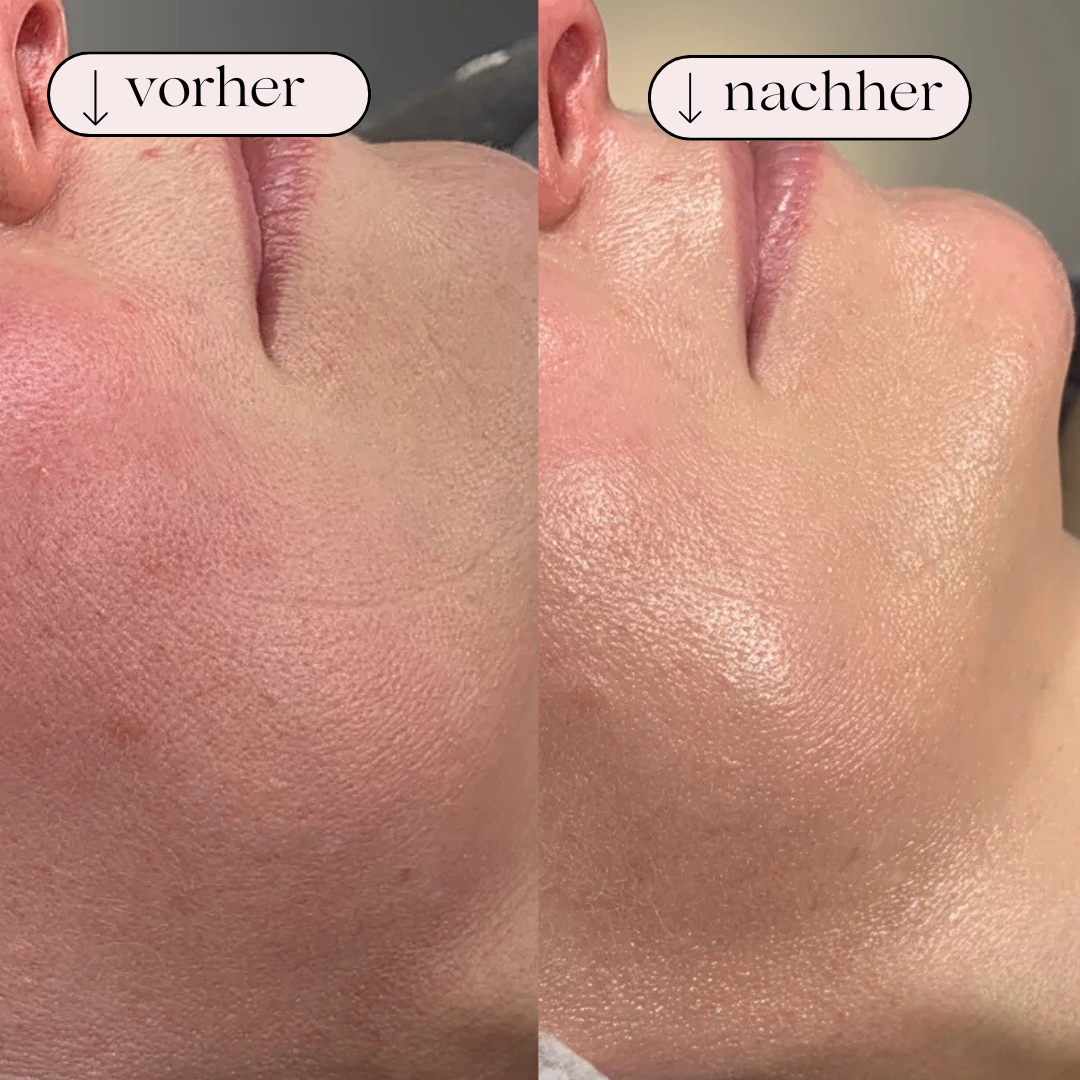 Porerensende hydrodermabrasion – Ansigtsrensning med brint og ilt