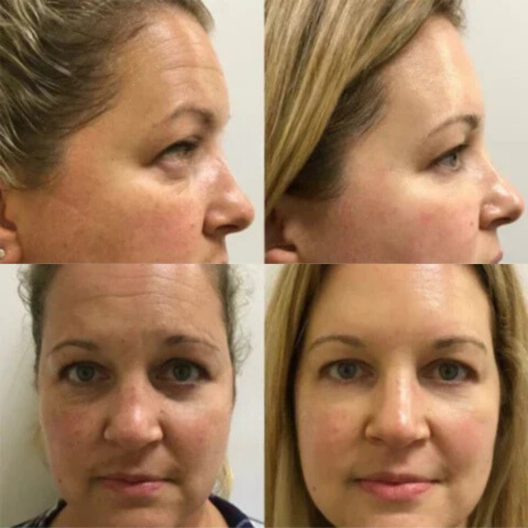 Wrinkle-free skin in just minutes!