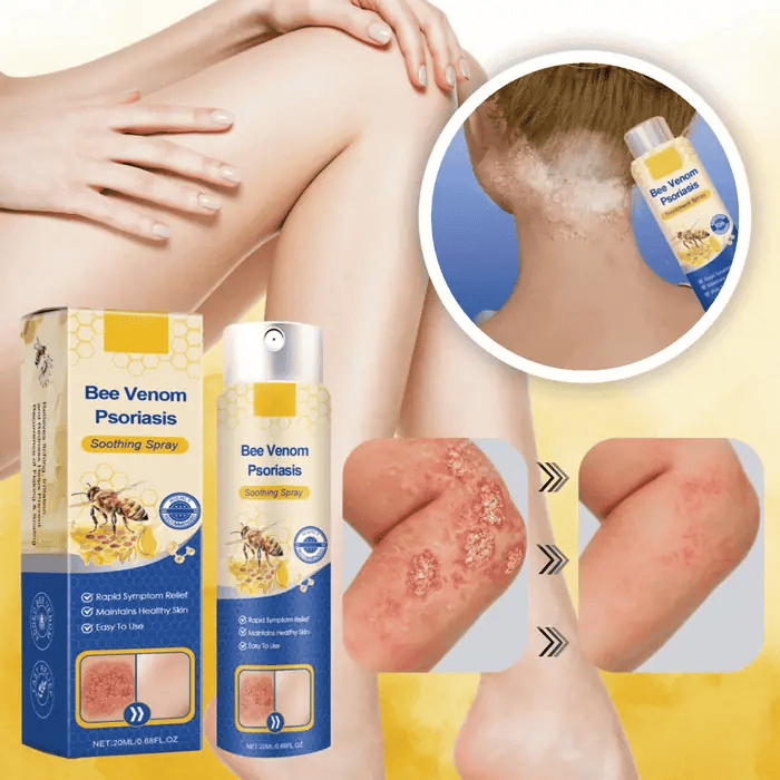 Øjeblikkelig lindring af genstridig psoriasis