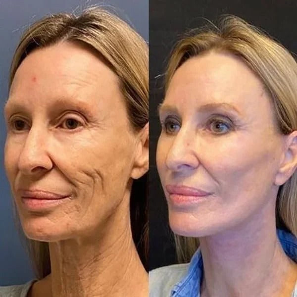 Wrinkle-free skin in just minutes!