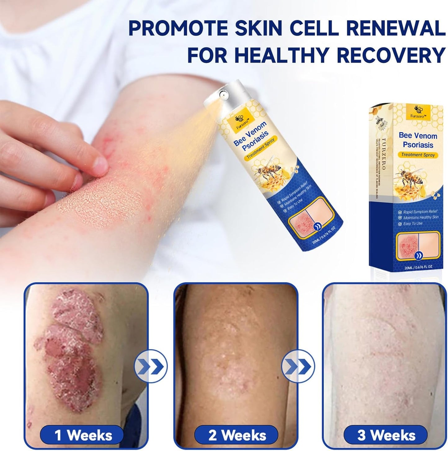 Øjeblikkelig lindring af genstridig psoriasis