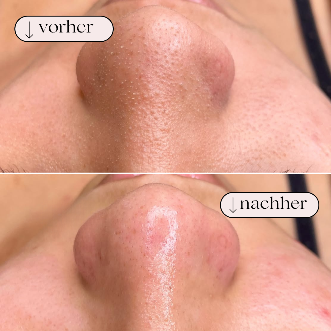 Porerensende hydrodermabrasion – Ansigtsrensning med brint og ilt
